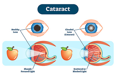 Who Develops Cataracts?